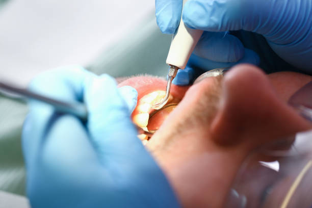 Best Dental Abscess Treatment in Wapakoneta, OH