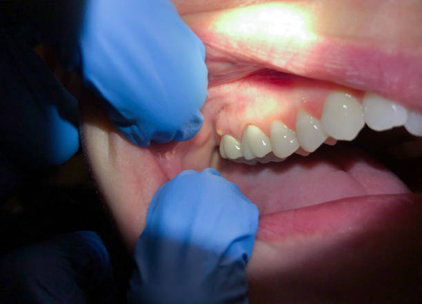 Best Emergency Treatment for Oral Infections in Wapakoneta, OH
