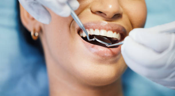 Best Knocked-Out Tooth (Avulsed Tooth) Treatment in Wapakoneta, OH